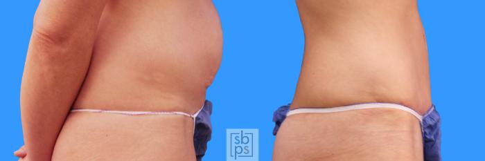Before & After Tummy Tuck Case 224 View #3 View in Torrance, CA