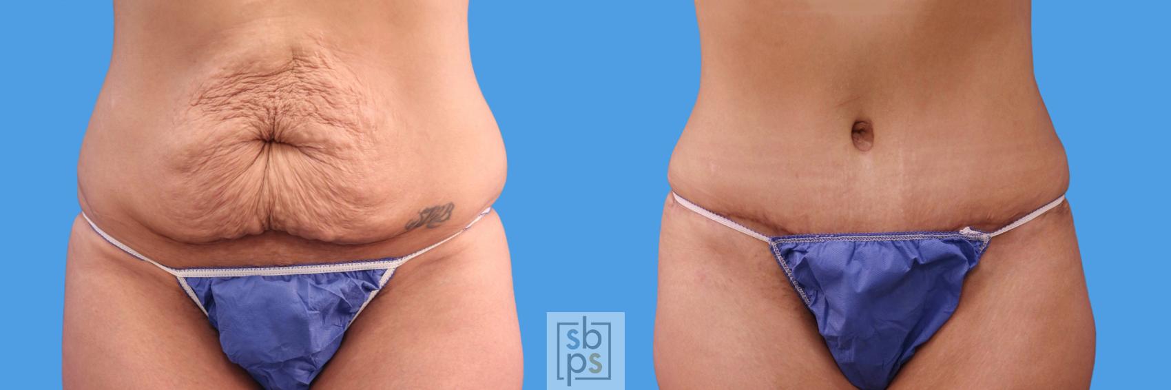 Before & After Liposuction Case 238 View #1 View in Torrance, CA