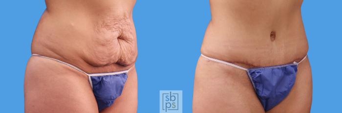 Before & After Liposuction Case 238 View #2 View in Torrance, CA
