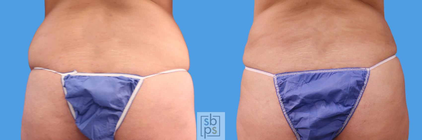 Before & After Tummy Tuck Case 238 View #4 View in Torrance & Los Angeles, CA, CA