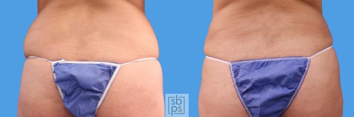 Before & After Liposuction Case 238 View #4 View in Torrance, CA