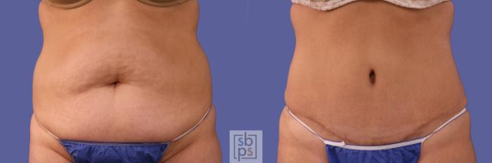 Before & After Tummy Tuck Case 253 View #1 View in Torrance, CA