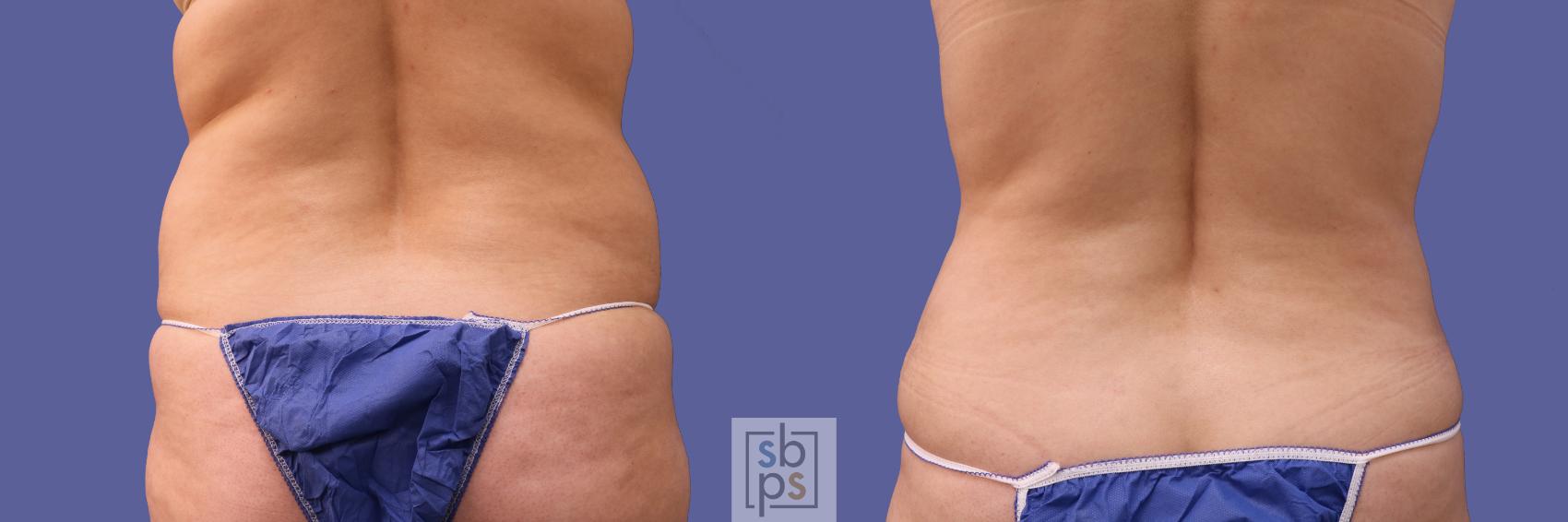 Before & After Tummy Tuck Case 253 View #2 View in Torrance & Los Angeles, CA, CA