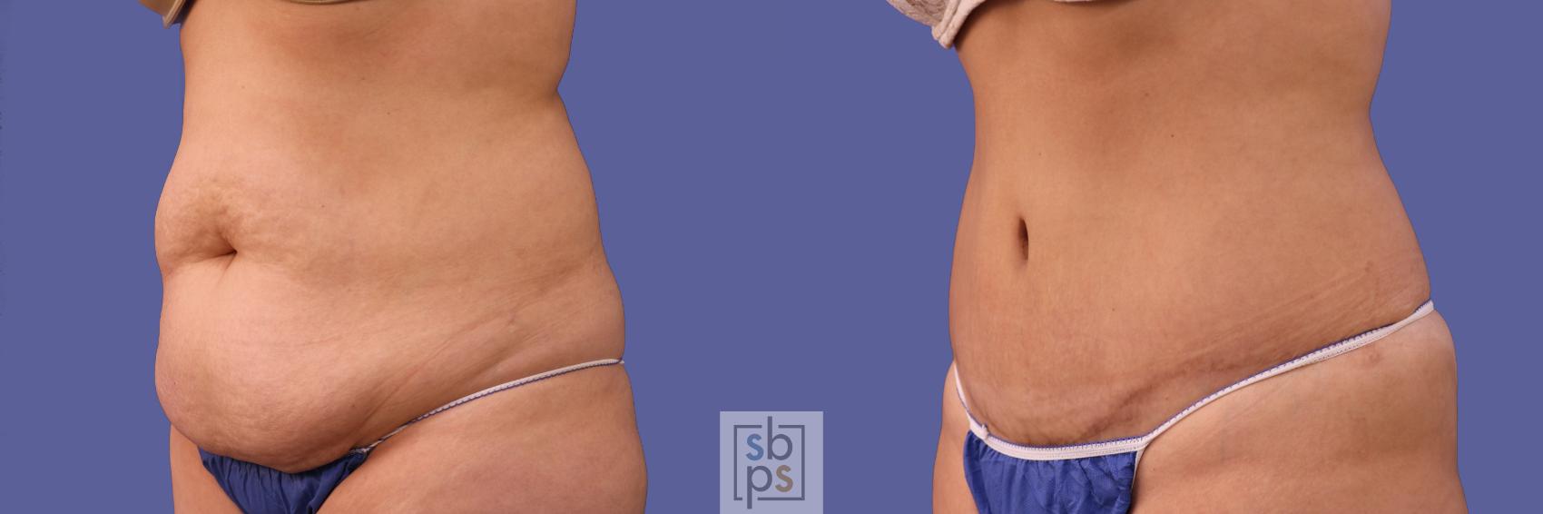 Before & After Tummy Tuck Case 253 View #3 View in Torrance & Los Angeles, CA, CA