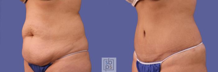 Before & After Tummy Tuck Case 253 View #3 View in Torrance, CA