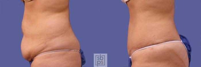 Before & After Tummy Tuck Case 253 View #4 View in Torrance, CA