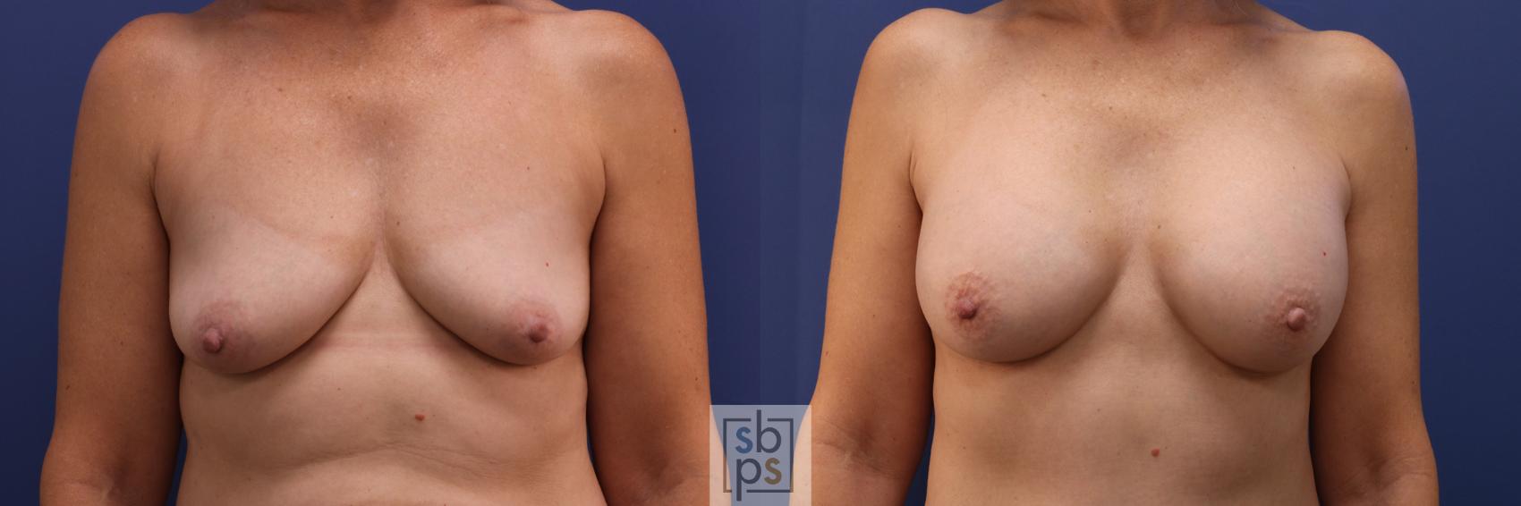 Before & After Liposuction Case 278 View #1 View in Torrance, CA