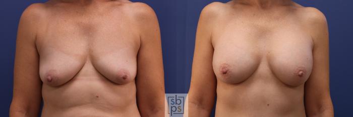 Before & After Breast Augmentation Case 278 View #1 View in Torrance, CA
