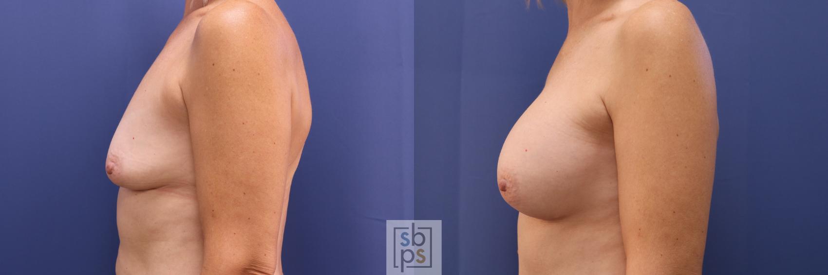 Before & After Liposuction Case 278 View #2 View in Torrance, CA