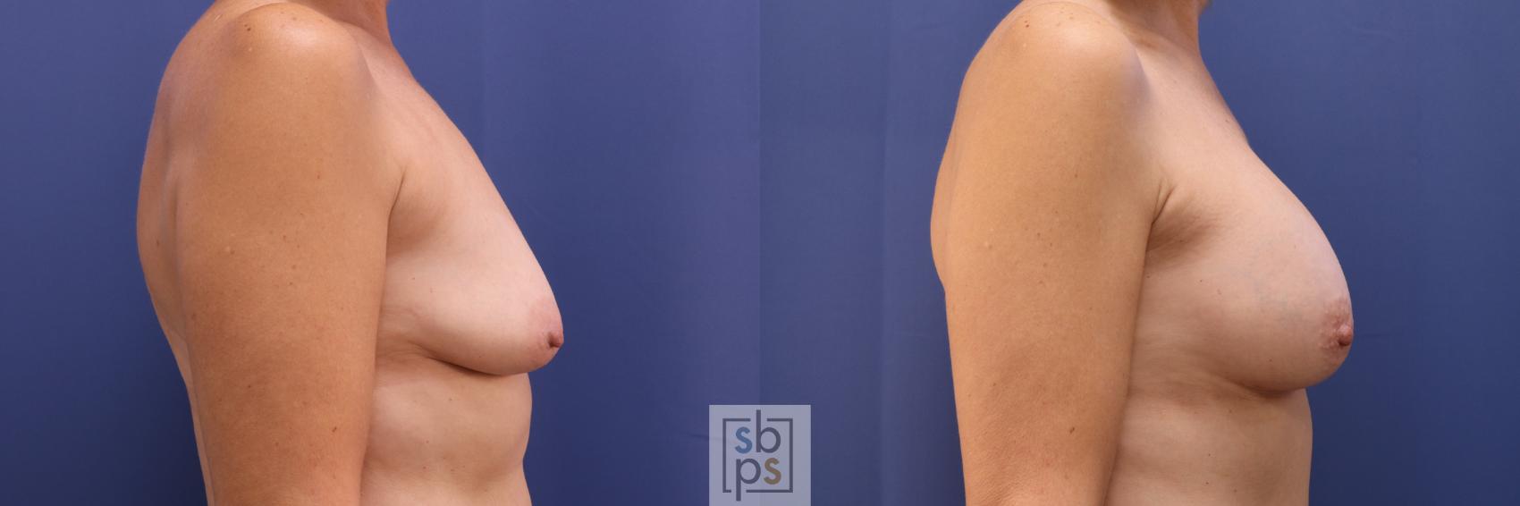Before & After Liposuction Case 278 View #4 View in Torrance, CA