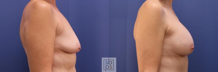 Before & After Breast Augmentation Case 278 View #4 View in Torrance, CA