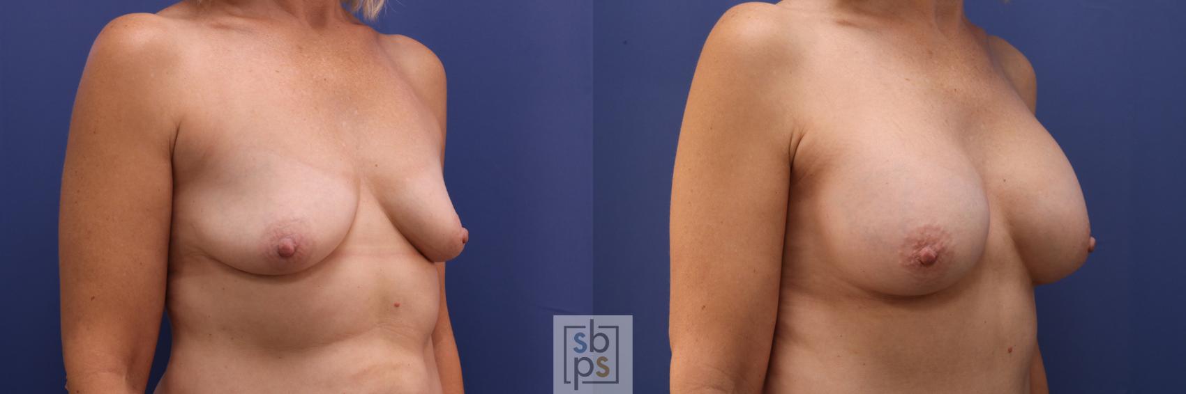 Before & After Liposuction Case 278 View #5 View in Torrance, CA