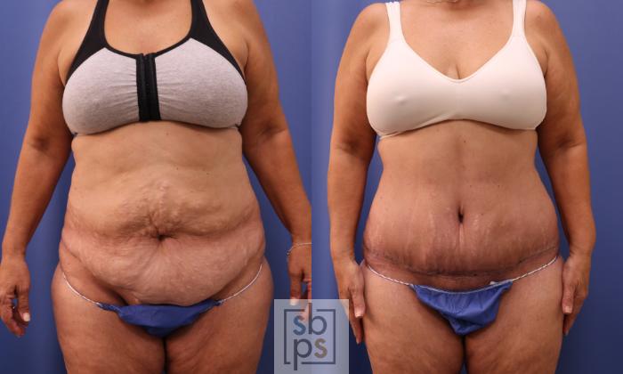 Before & After Tummy Tuck Case 279 View #1 View in Torrance, CA