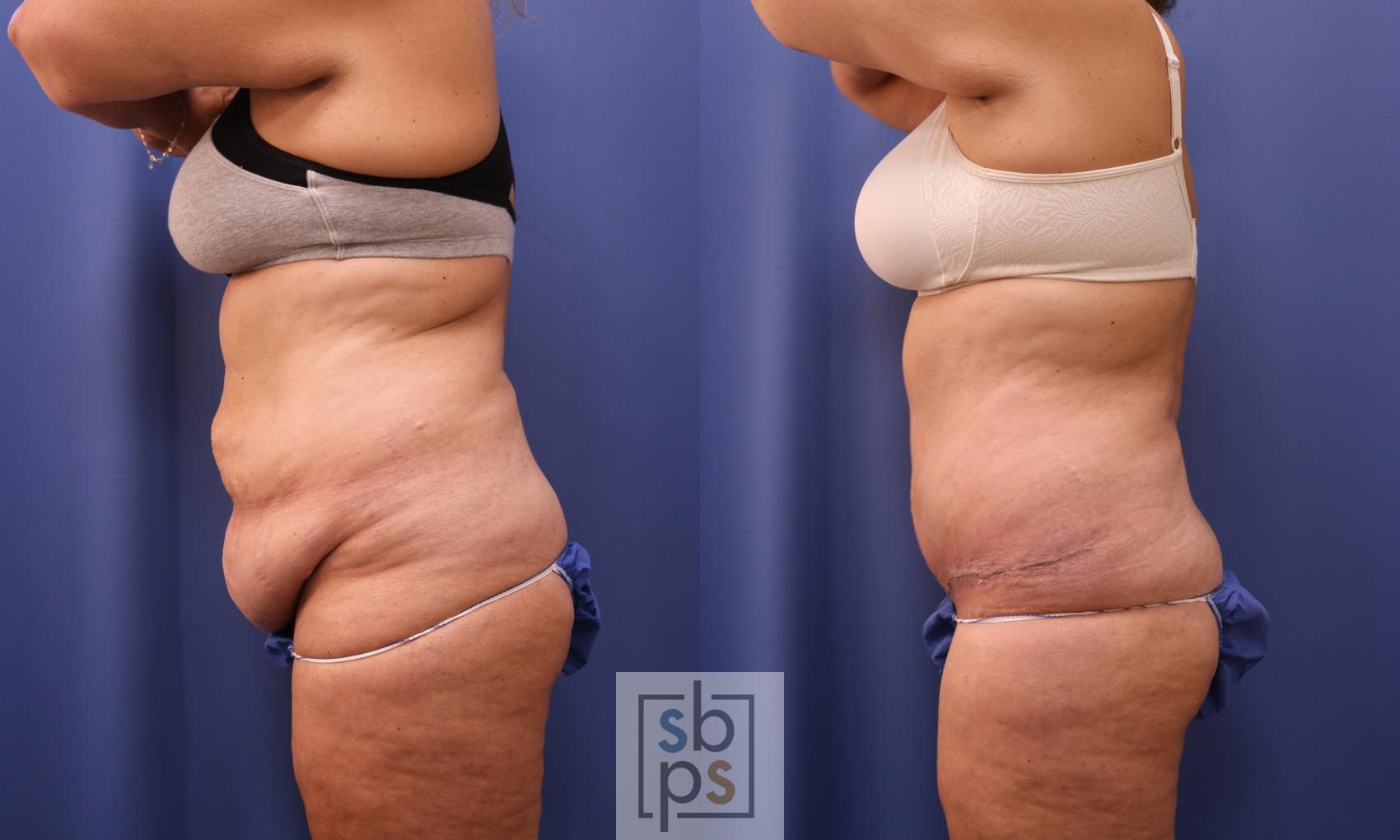 Before & After Tummy Tuck Case 279 View #2 View in Torrance & Los Angeles, CA, CA