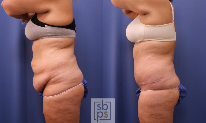 Before & After Tummy Tuck Case 279 View #2 View in Torrance, CA