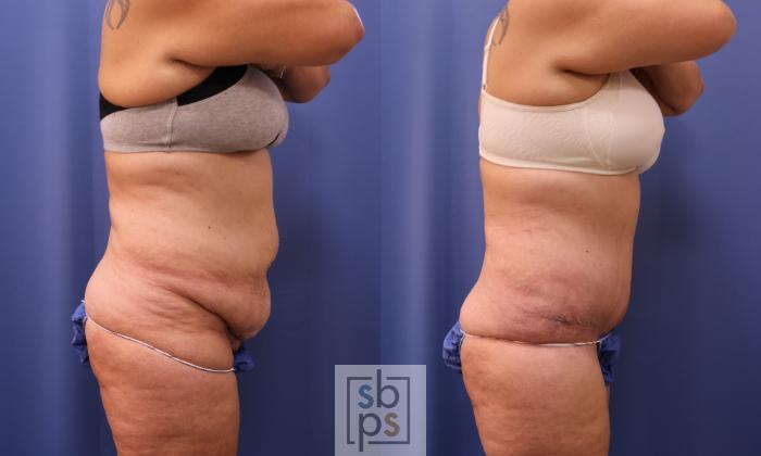 Before & After Tummy Tuck Case 279 View #3 View in Torrance, CA