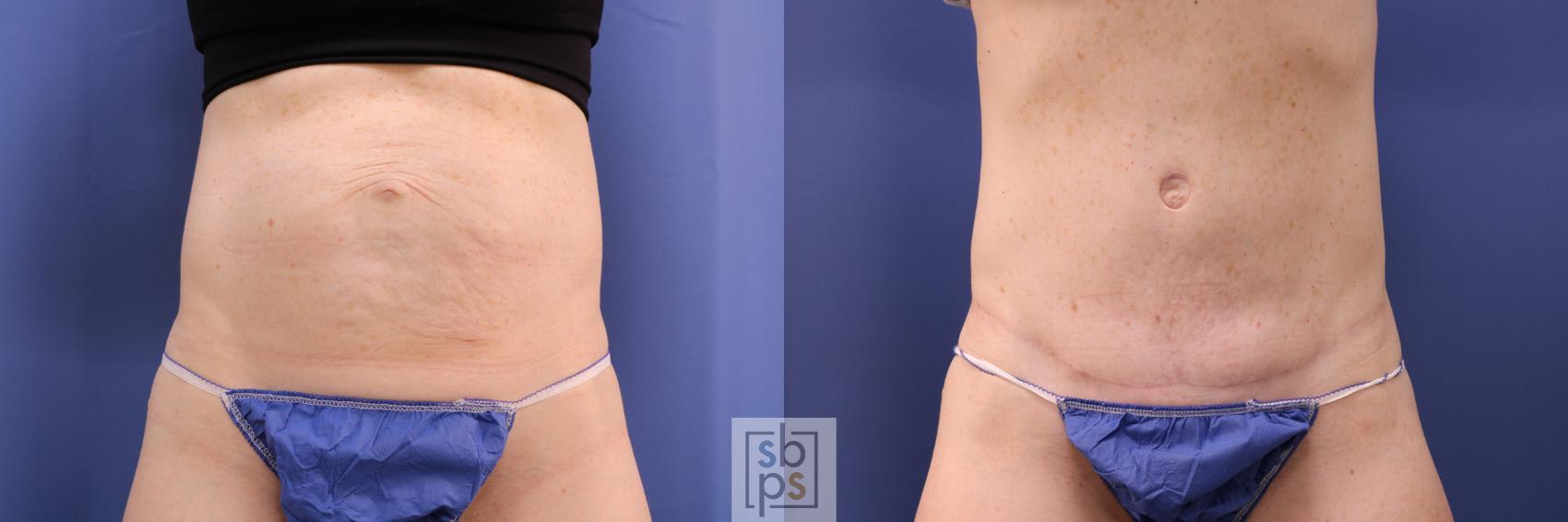 Before & After Tummy Tuck Case 285 View #1 View in Torrance, CA