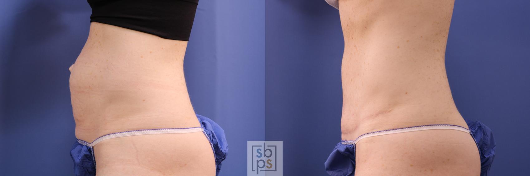 Before & After Tummy Tuck Case 285 View #2 View in Torrance & Los Angeles, CA, CA
