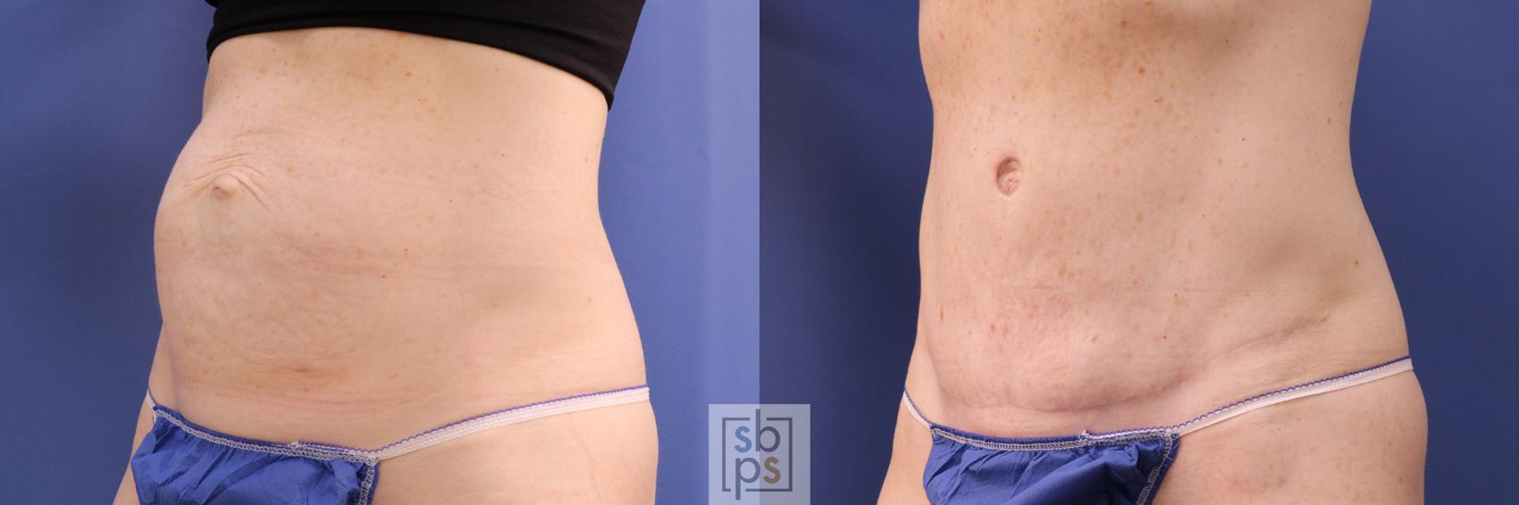 Before & After Tummy Tuck Case 285 View #3 View in Torrance & Los Angeles, CA, CA