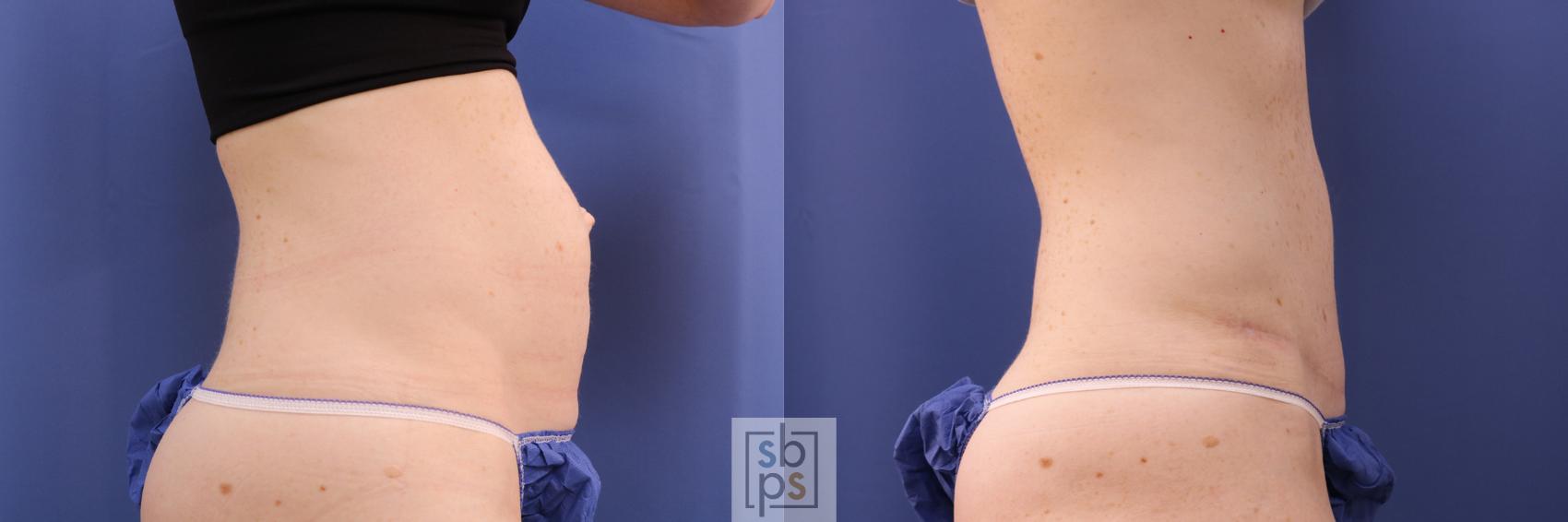 Before & After Tummy Tuck Case 285 View #4 View in Torrance & Los Angeles, CA, CA
