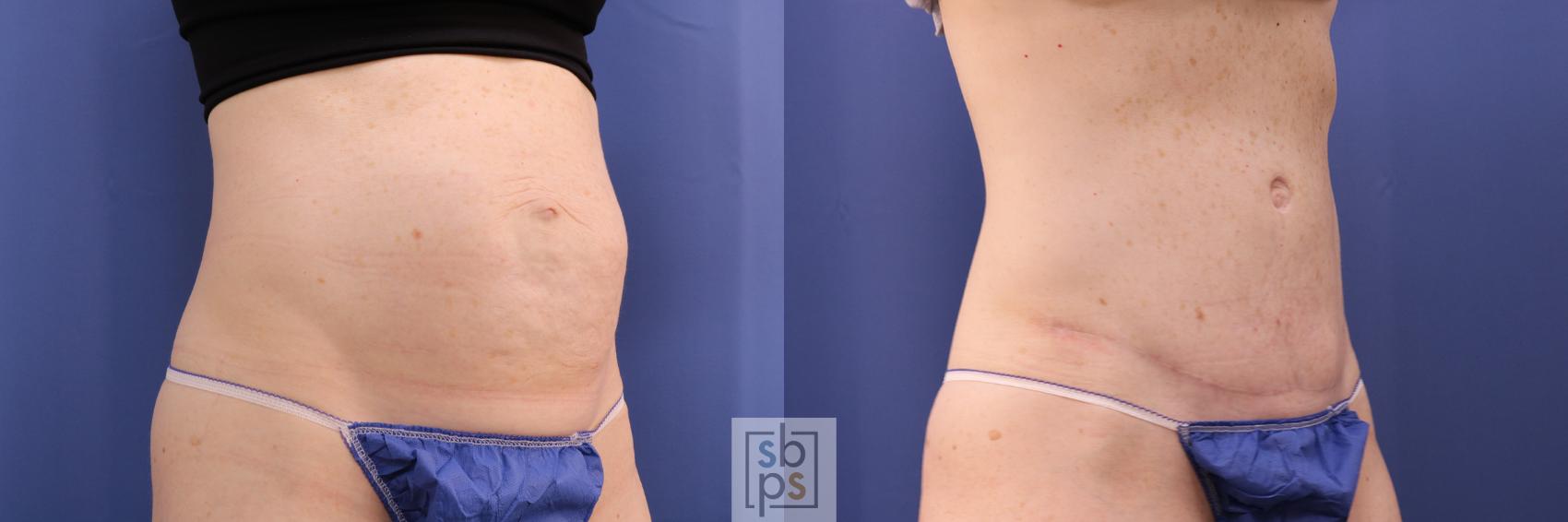 Before & After Tummy Tuck Case 285 View #5 View in Torrance & Los Angeles, CA, CA