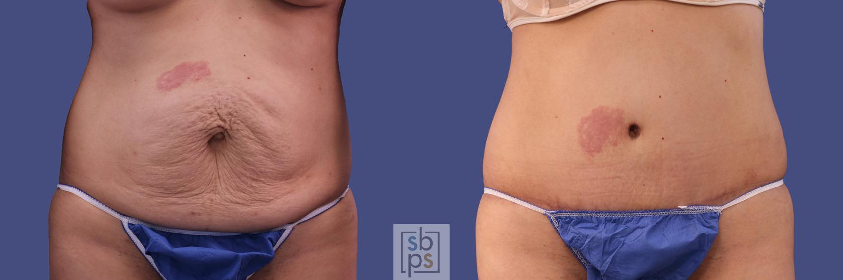 Before & After Tummy Tuck Case 286 View #1 View in Torrance, CA