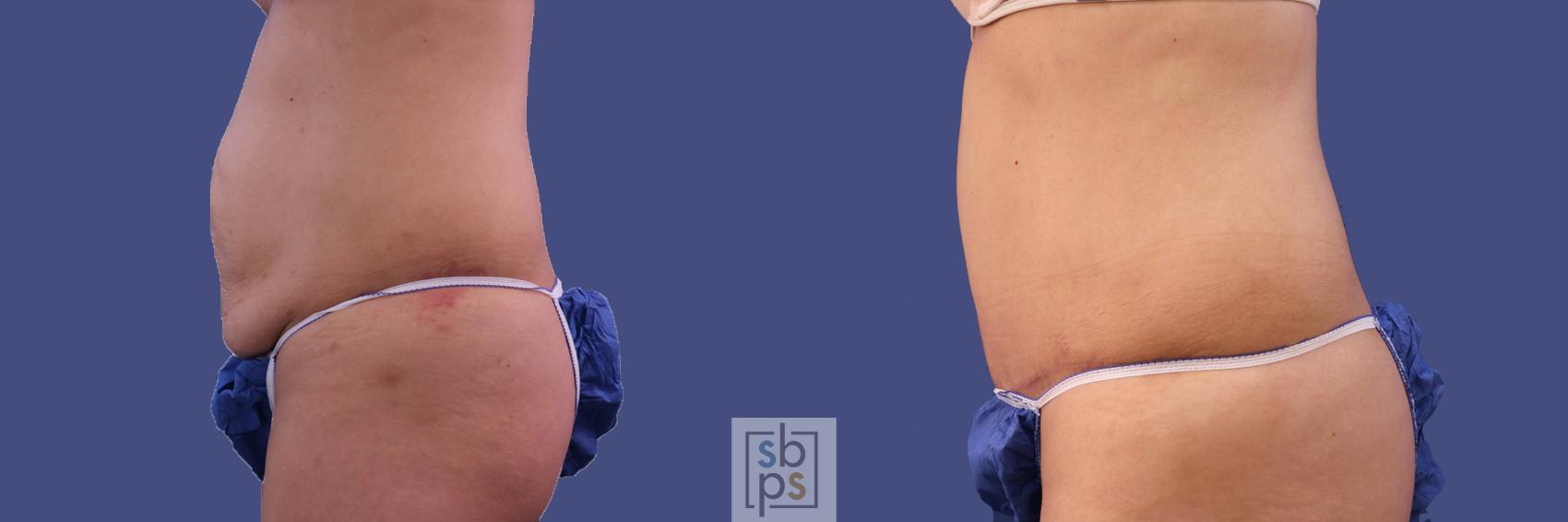 Before & After Tummy Tuck Case 286 View #2 View in Torrance, CA