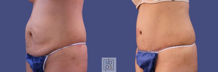 Before & After Tummy Tuck Case 286 View #3 View in Torrance, CA