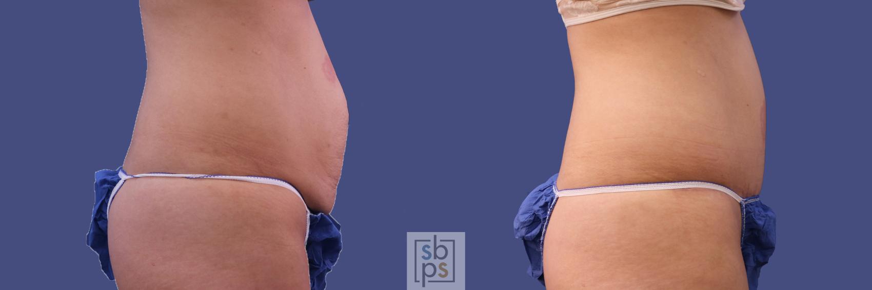 Before & After Tummy Tuck Case 286 View #4 View in Torrance, CA