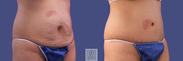 Before & After Tummy Tuck Case 286 View #5 View in Torrance, CA