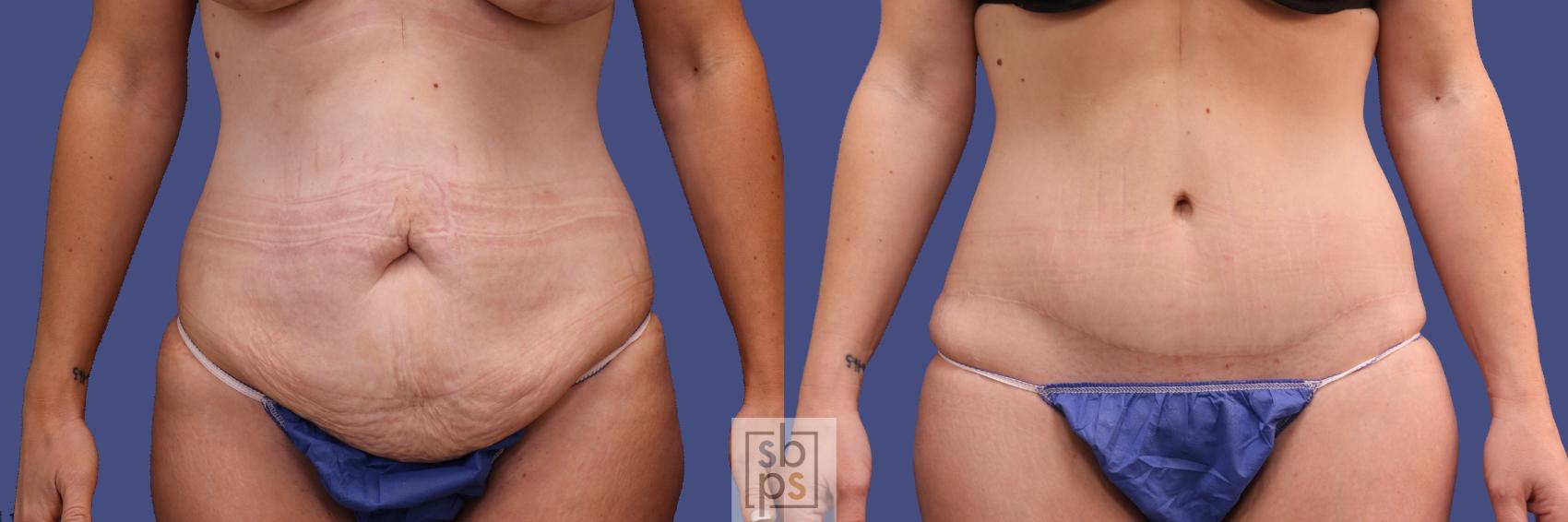 Before & After Tummy Tuck Case 290 View #1 View in Torrance, CA