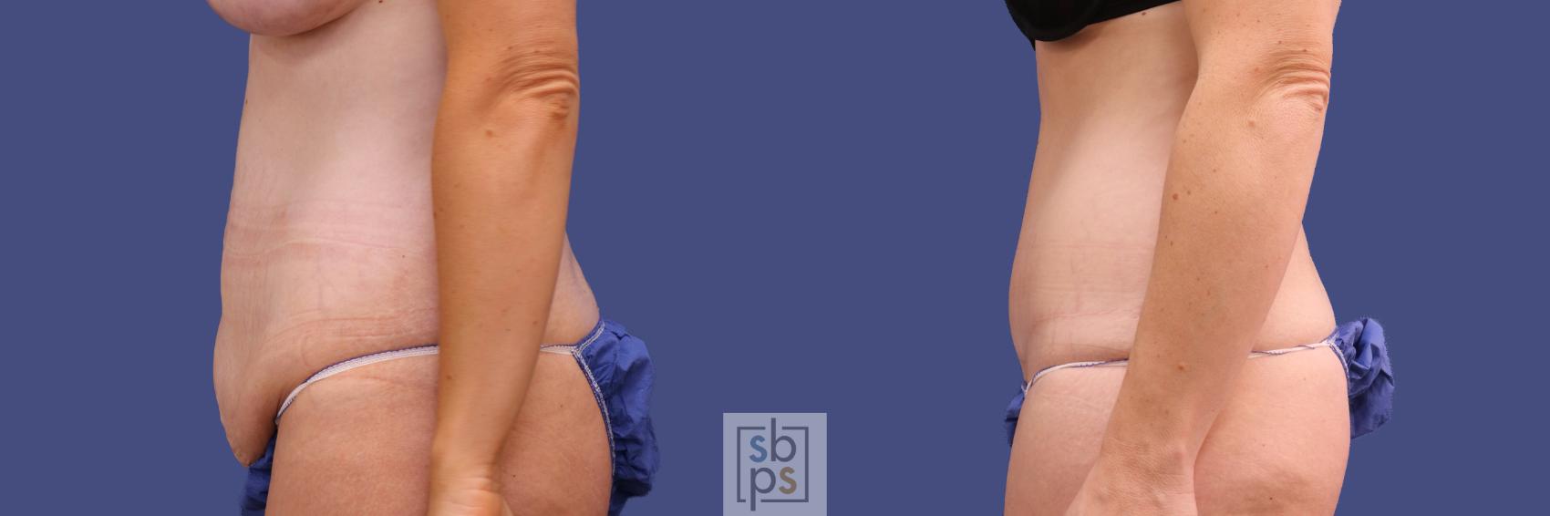 Before & After Tummy Tuck Case 290 View #2 View in Torrance & Los Angeles, CA, CA