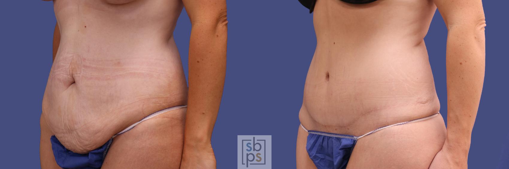 Before & After Tummy Tuck Case 290 View #3 View in Torrance & Los Angeles, CA, CA