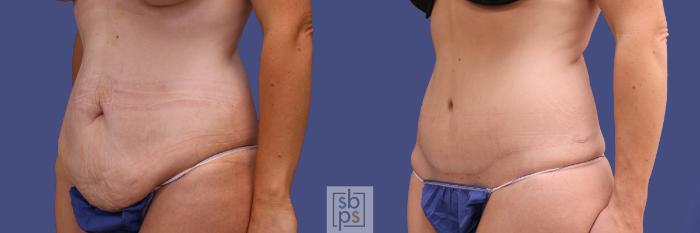 Before & After Tummy Tuck Case 290 View #3 View in Torrance, CA