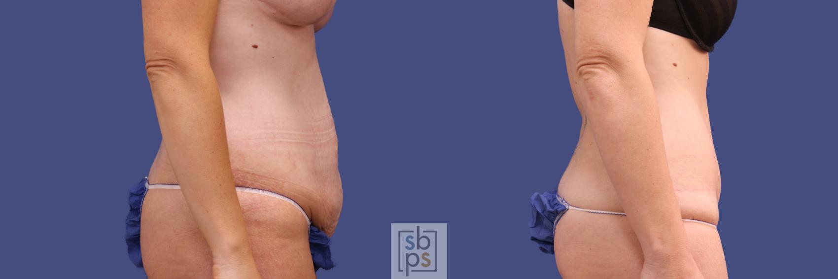 Before & After Tummy Tuck Case 290 View #4 View in Torrance & Los Angeles, CA, CA