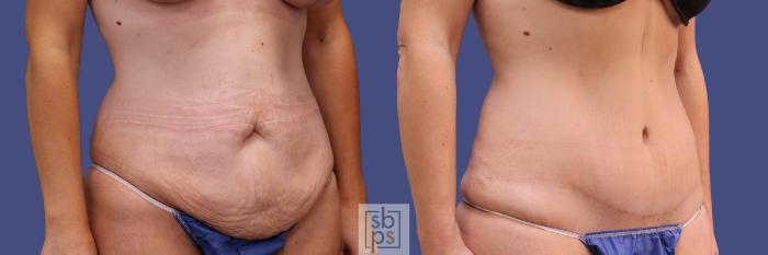 Before & After Tummy Tuck Case 290 View #5 View in Torrance, CA