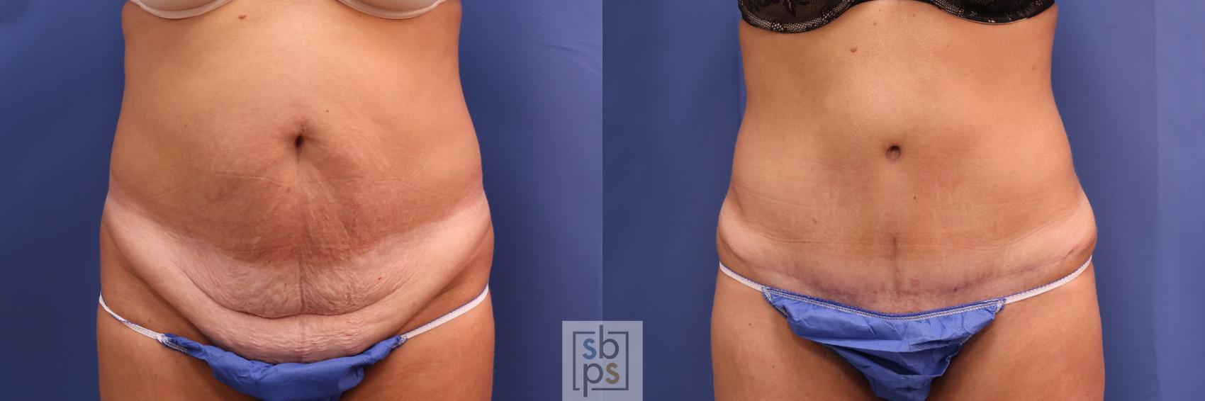 Before & After Liposuction Case 305 View #1 View in Torrance, CA