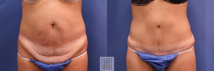 Before & After Tummy Tuck Case 305 View #1 View in Torrance, CA