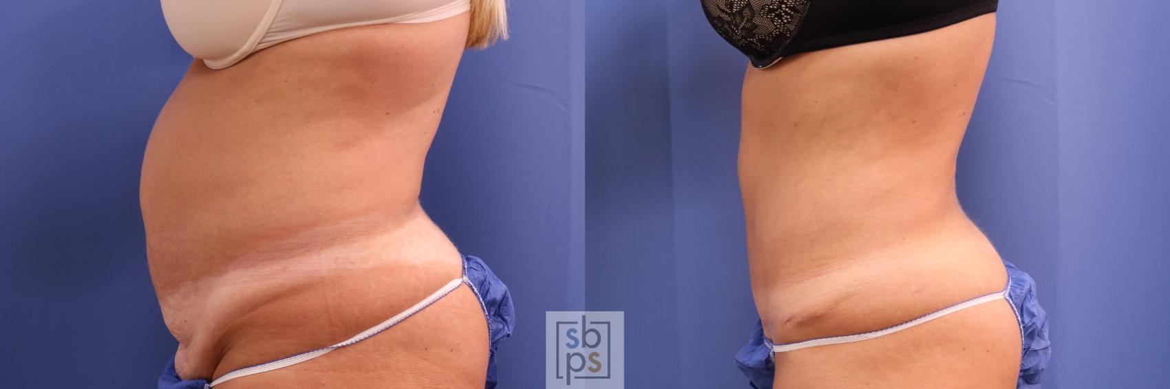 Before & After Liposuction Case 305 View #2 View in Torrance, CA