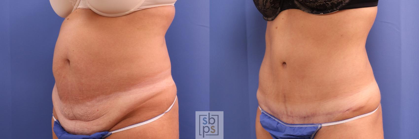 Before & After Liposuction Case 305 View #3 View in Torrance, CA