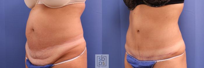 Before & After Tummy Tuck Case 305 View #3 View in Torrance, CA