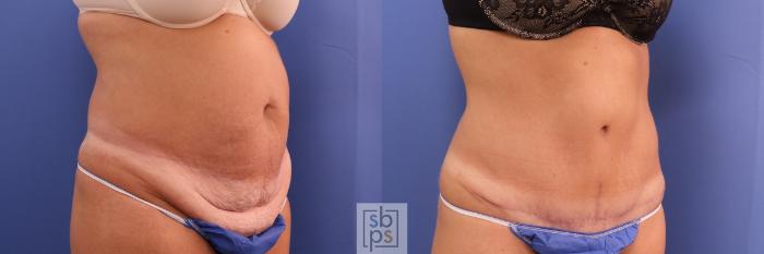 Before & After Tummy Tuck Case 305 View #4 View in Torrance, CA