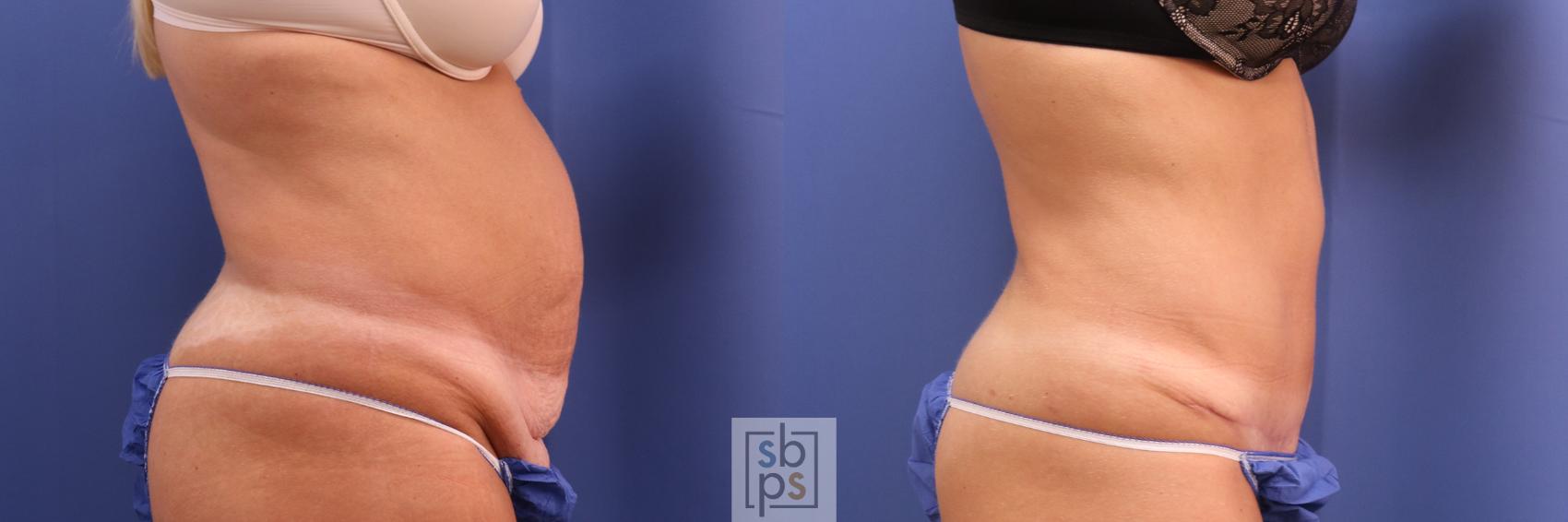 Before & After Liposuction Case 305 View #5 View in Torrance, CA
