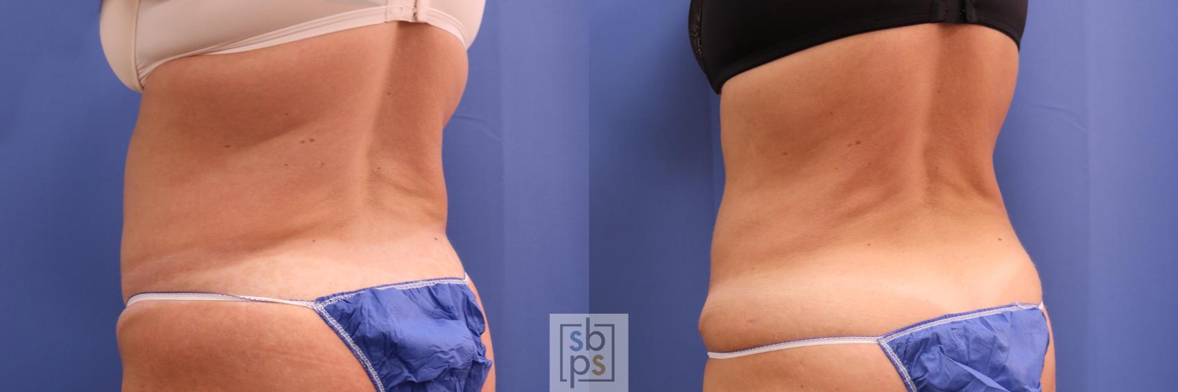 Before & After Liposuction Case 305 View #6 View in Torrance, CA