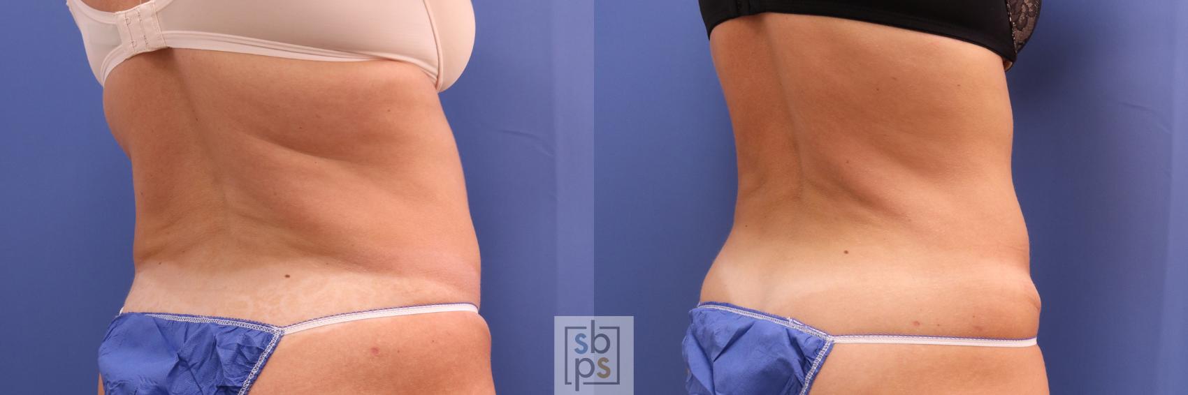 Before & After Liposuction Case 305 View #7 View in Torrance, CA