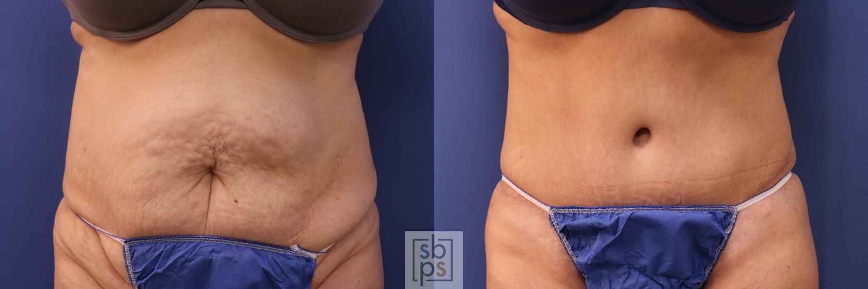 Before & After Tummy Tuck Case 320 View #1 View in Torrance, CA