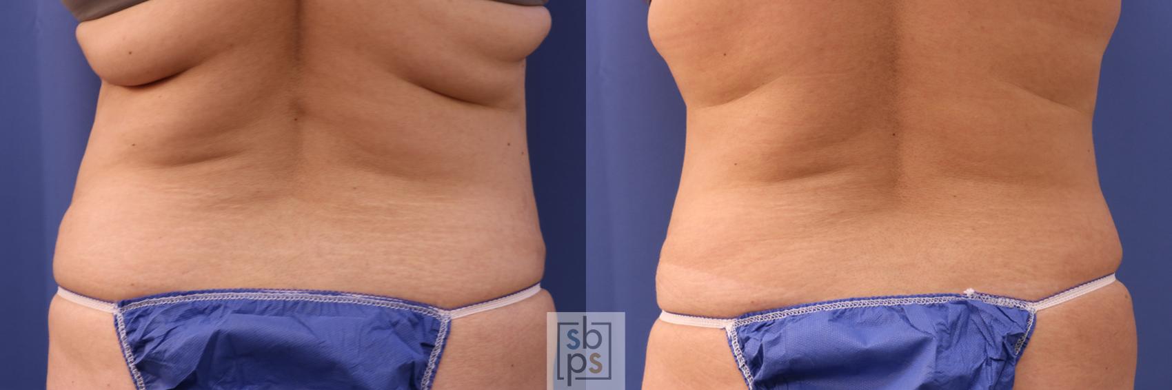 Before & After Tummy Tuck Case 320 View #2 View in Torrance & Los Angeles, CA, CA