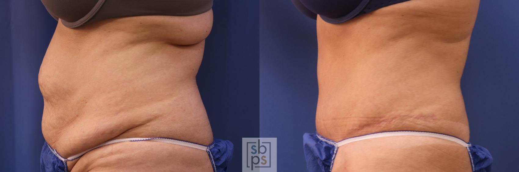 Before & After Tummy Tuck Case 320 View #3 View in Torrance & Los Angeles, CA, CA