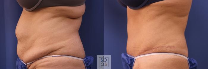 Before & After Tummy Tuck Case 320 View #3 View in Torrance, CA