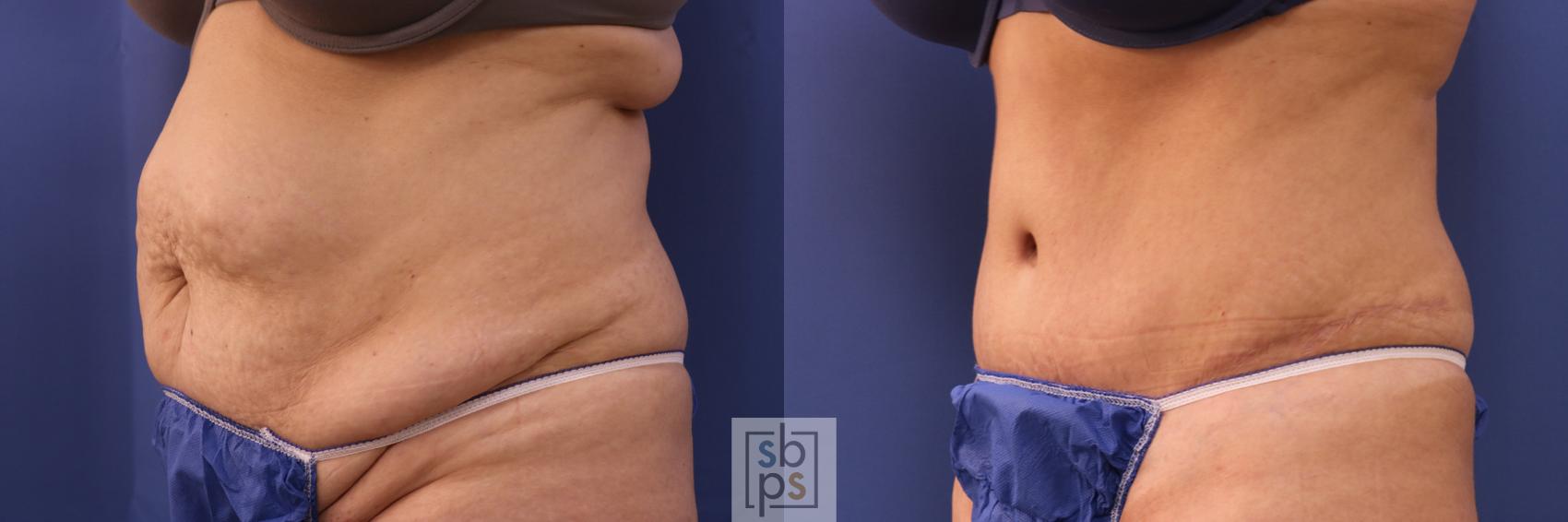 Before & After Tummy Tuck Case 320 View #4 View in Torrance & Los Angeles, CA, CA